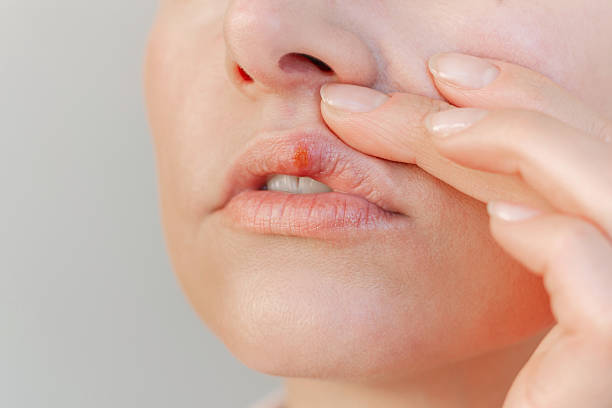 istock A young woman suffering from herpes on her lips in the acute stage. 2204726676