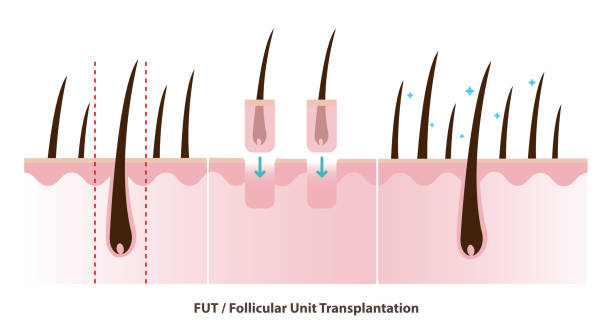 istock FUT hair transplant vector illustration isolated on white background. 2204856744