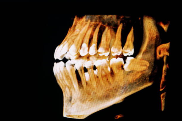 an extracted wisdom tooth with a purulent cyst crossed out with a pen on an x-ray image