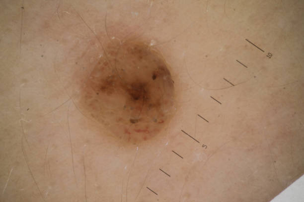 Benign neoplasms on the skin. Dermatoscopy. Increased by 20 times. Soft focus