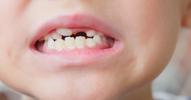 istock Child cavities and crooked teeth 2205345103