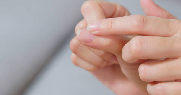 Woman touching her cracked fingernail