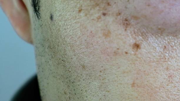 Close-up of blemishes on the face of a Japanese man