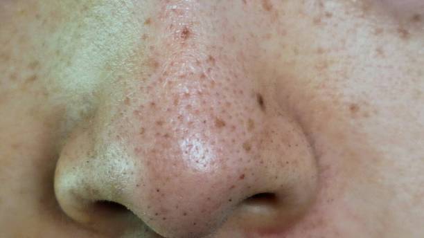 istock Blackheads on Japanese men's noses 2205527695