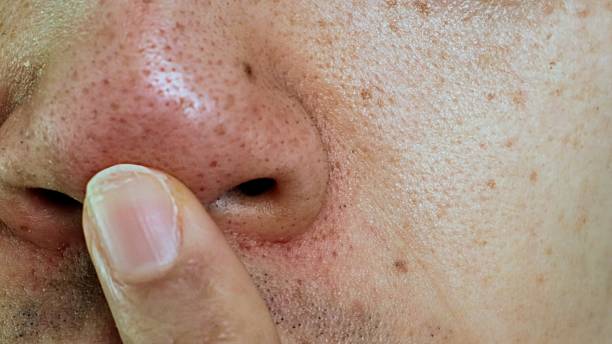 istock Blackheads on Japanese men's noses 2205527724