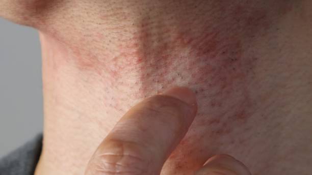 istock Japanese man scratching his inflamed skin 2205529334