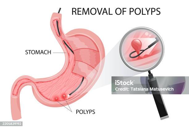 Polypectomy Image Cartoon Polyp Removal Procedure In Stomach Polyp Is Under Magnification Vector ...