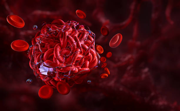 istock Blood clot in artery, emphasizing thrombosis, coagulation process, red blood cells, fibrin strands 2205912192