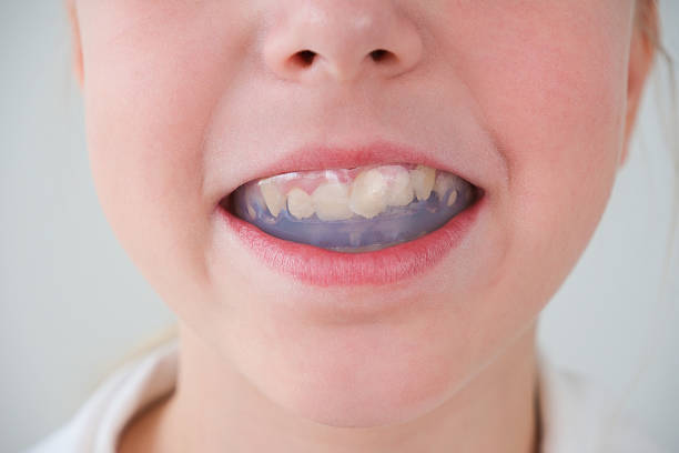 istock Dental simulator for teeth alignment . The child has mouth guards on his teeth. 2206339684