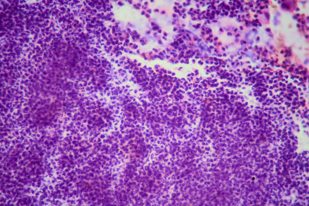 Medical themes: Bronchial lavage revealing tuberculosis granuloma
