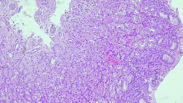 istock Human cell tissue under microscope in pathology laboratory. Microscopic picture of chronic gastric disease showing Helicobacter pylori bacterial infection, hematoxylin eosin staining 2206462780
