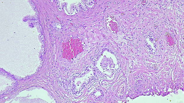 istock Photomicrograph showing histological features of benign prostatic hyperplasia in the anatomical pathology laboratory 2206462783