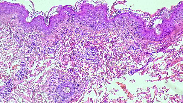Borderline lepromatous leprosy, Histological tissue under a microscope