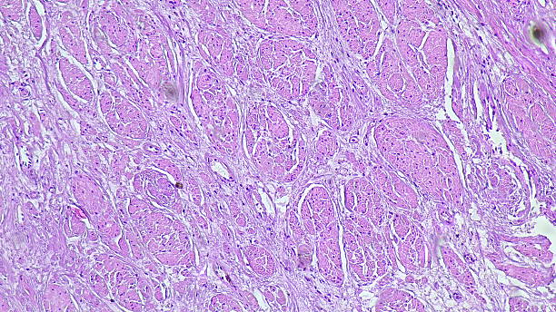 istock Photomicrograph showing histological features of benign prostatic hyperplasia in the anatomical pathology laboratory 2206462912