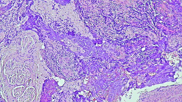 istock Photomicrograph of pyogenic granuloma, in digiti 3 manus dextra tumor under microscope in anatomical pathology laboratory 2206462932