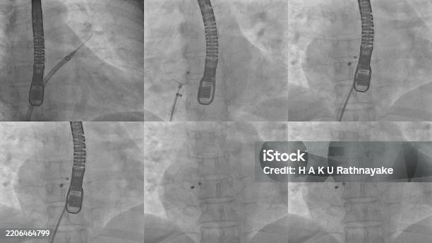 Patch Closure Atrial Septal Defect Closure Procedure Using Invasive Cardiology ...