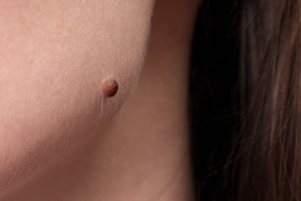 A woman has a large mole on her face. A tumor on the body. An example of a mole.