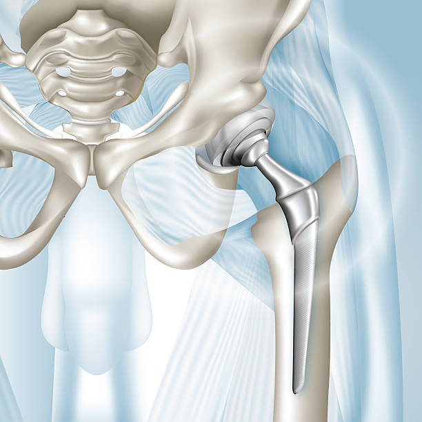 Hip arthroplasty Hip Replacement hip replacement stock illustrations