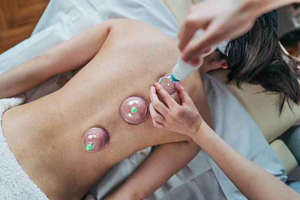Therapist applying suction cups to a patient's back, engaging in cupping therapy, a traditional practice in alternative medicine known for promoting relaxation and pain relief