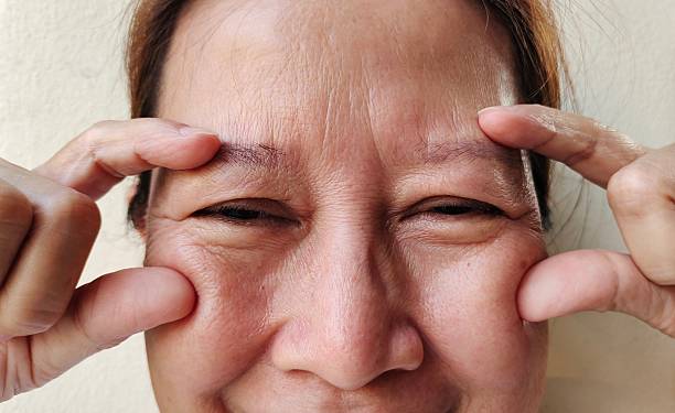 istock Forehead lines and swelling, ptosis and wrinkle. 2206670389