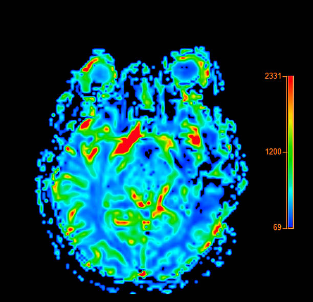 istock MRI brain perfusion imaging helps assess cerebral blood flow and tissue viability. 2207261314