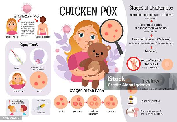 Chickenpox Pattern Vector Infographic Chickenpox Stock Illustration - Download Image Now ...