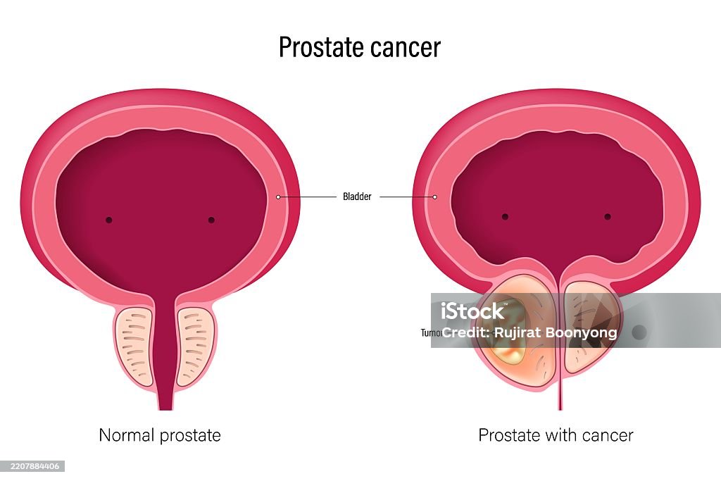Prostate Cancer Comparison Between Normal Prostate And Prostate With ...