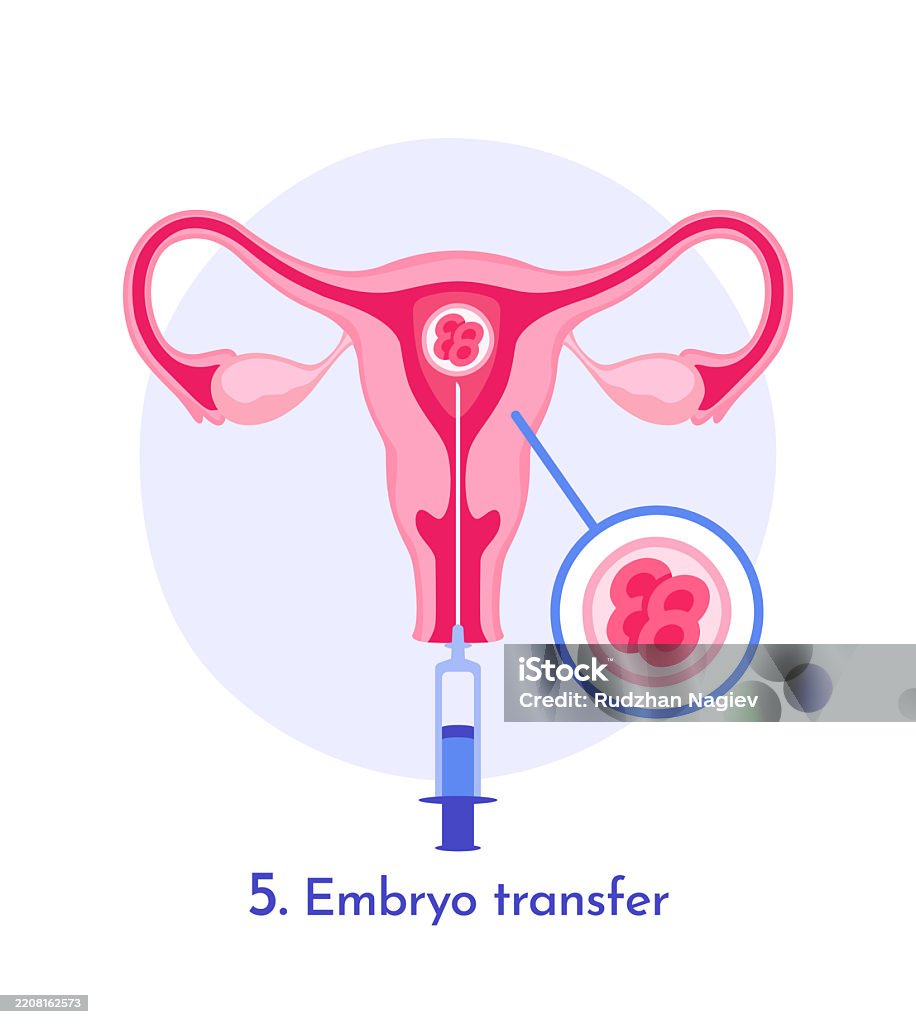 Transfert Embryon Embryo Transfer In Uterus Process Diagram Vector Illustration Stock ...