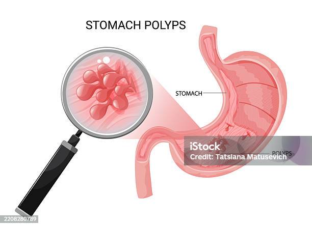 Defiant Polyp Stomach Polyps Multiple Gastric Polyps Under Magnification Digestive ...