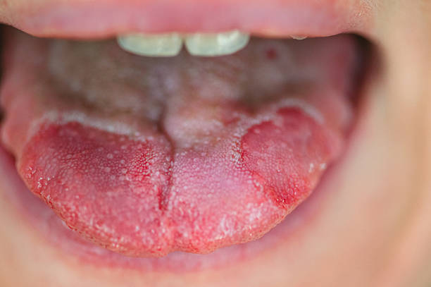 Close up of a child's mouth with a folded tongue. Medical inspection concept