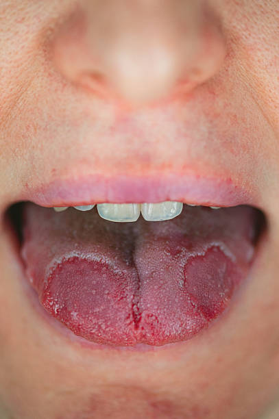 istock Severe Geographic tongue 2208313010