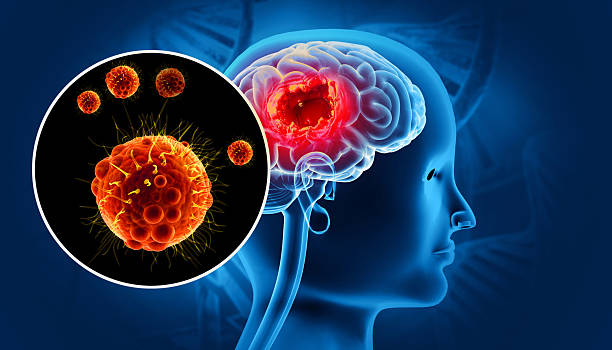 istock Brain tumor or brain cancer. 3d illustration 2208477107