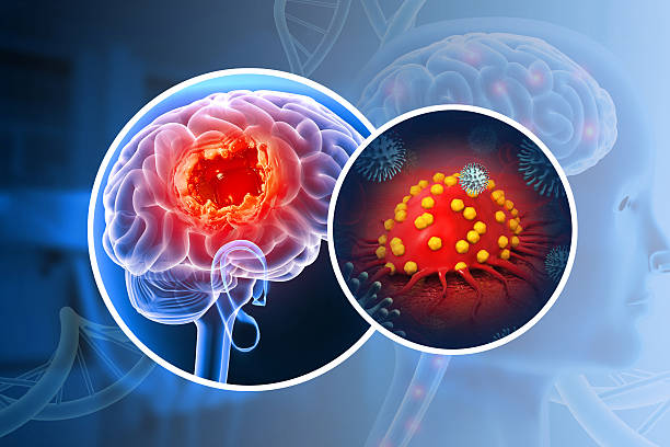 istock Brain tumor or brain cancer. 3d illustration 2208477386