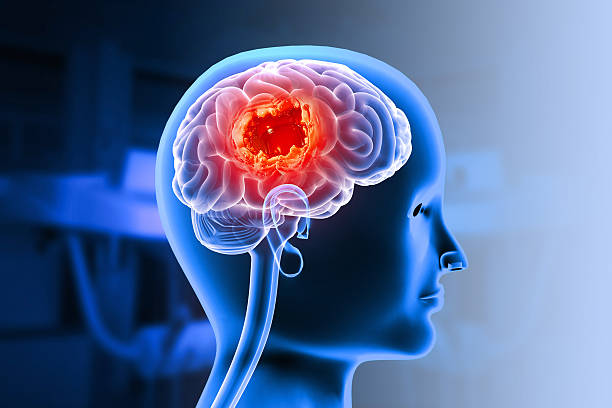 istock Brain tumor or brain cancer. 3d illustration 2208477415