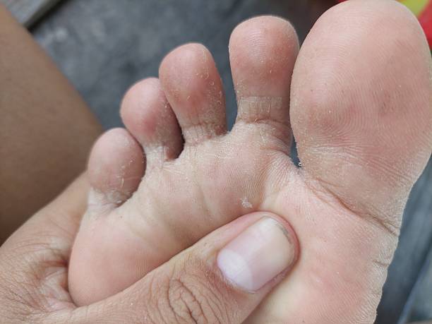 istock Peeling skin on feet 2208692451