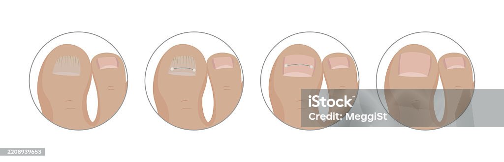 Toenail Toenail Method Podiatrist Applying Toenail Correction Staples Step By Step Stock ...