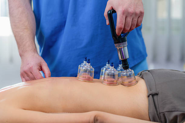 istock Woman receiving cupping therapy on her back during a physical therapy session. The suction cups help relieve muscle tension, improve circulation, and promote pain relief and relaxation. 2208945081