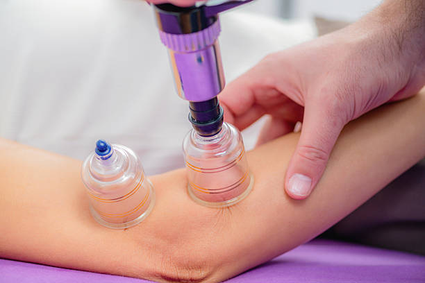 Cupping therapy for elbow during a physical therapy session. The suction cups help reduce pain, improve circulation, and relieve muscle tension for better mobility and recovery.