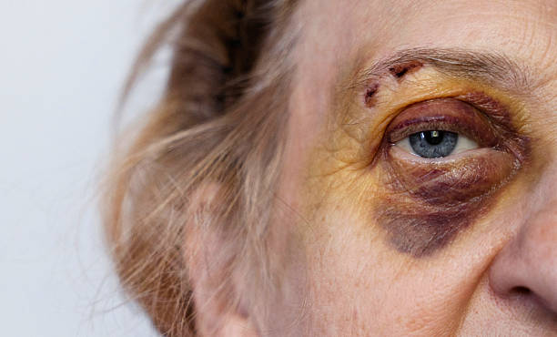 istock Old woman eye with a purple bruise 2209029720
