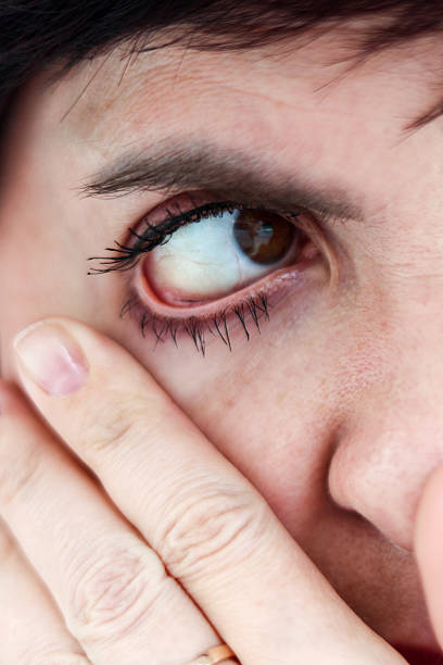 istock An eyelash fell out and got into a person's eye, close-up 2209177011