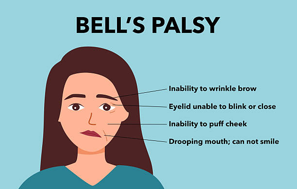 Bells Pulse 80+ Bell Palsy Stock Photos, Pictures & Royalty-Free Images - iStock