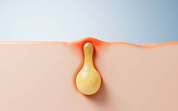 istock Pore acne and skin health concept, 3d rendering. 2209808788