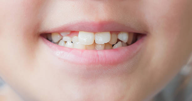 istock Child cavities and crooked teeth 2210121795
