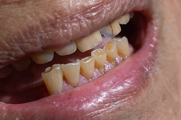 istock Attrition tooth due to interaction with other teeth in elderly woman. 2210152176