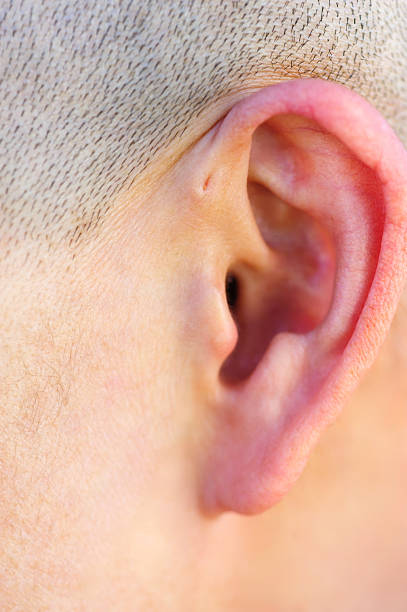 A preauricular sinus appears as a very small pit just in front of the external ear, these sinuses can drain a foul smelling discharge, and when this happens, they are prone to chronic infection.