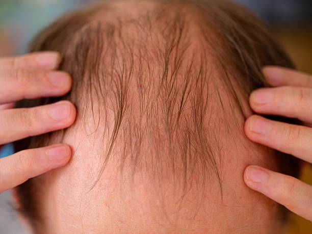 istock Man showing hair loss on his head. 2210227971