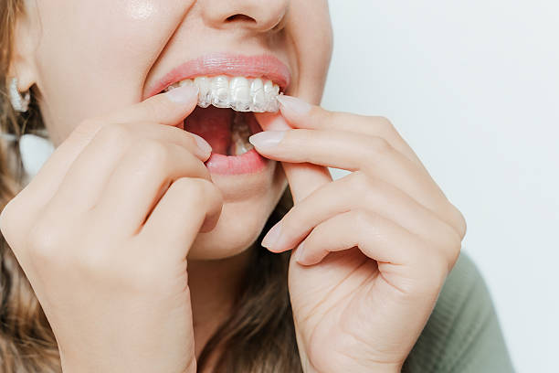 istock Woman Placing Clear Dental Aligner On Upper Teeth 2210279813
