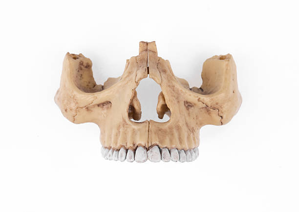 Plaster cast of a denture bite of a 13 year old person for medical examination