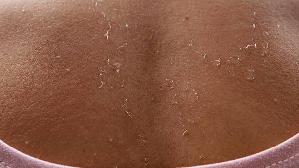 istock Sunburned skin peeling on a woman's back reveals the healing process following excessive sun exposure during vacation 2210530056