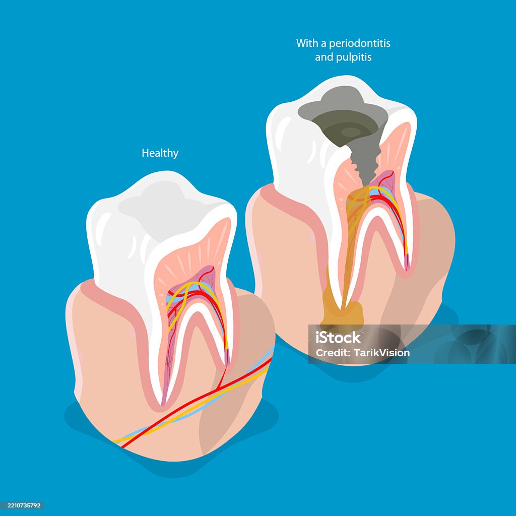 Tooth Problem Illustration 3d Isometric Flat Vector Illustration Of Tooth Issues Stock ...